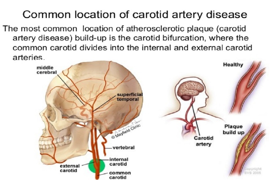 common carotid artery bifurcation